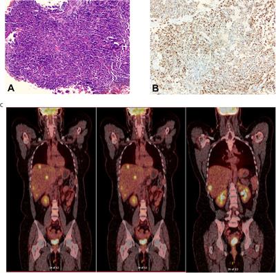 Case Report: Circulating Tumor DNA Fraction Analysis Using Ultra-Low-Pass Whole-Genome Sequencing Correlates Response to Chemoradiation and Recurrence in Stage IV Small-Cell Carcinoma of the Cervix - A Longitudinal Study